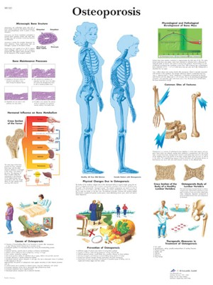 Osteoporosis