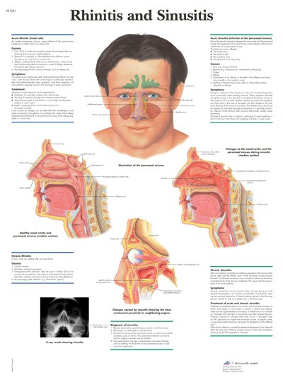 All Products - Wandkaart: Rhinitis And Sinusitis