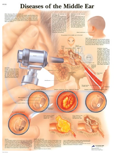 Diseases Of The Middle Ear