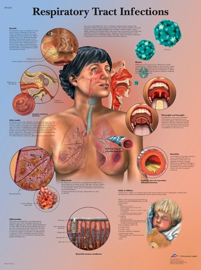 Respiratory Tract Infections