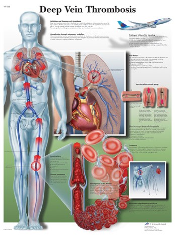 Deep Vein Thrombosis