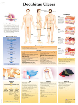 Ducubitis Ulcers